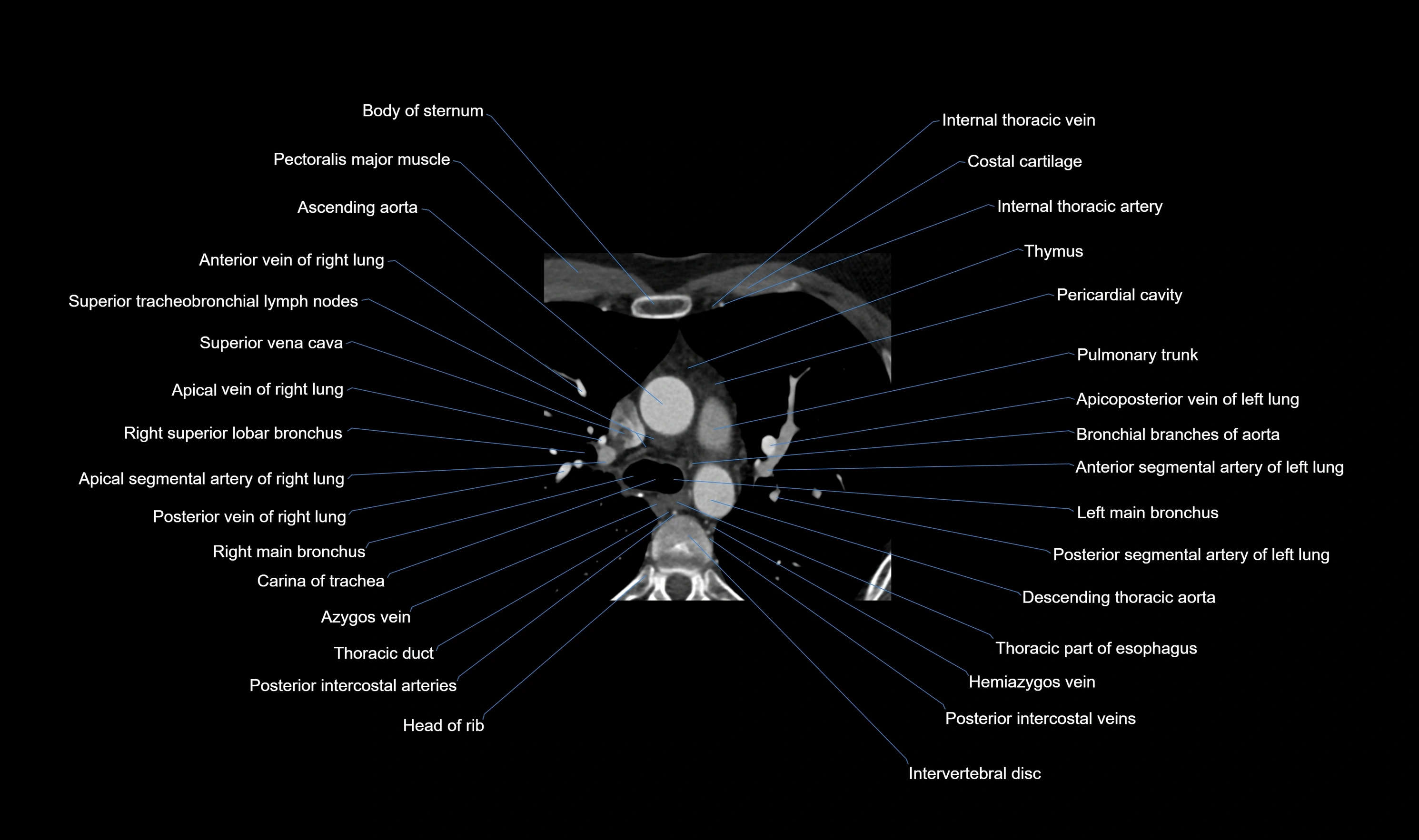 CT heart (coronary angiogram) axial view cross sectional anatomy labelled radiology image-00003.webp